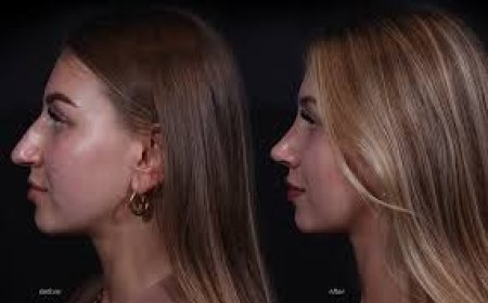 Discovering Excellence: Your Comprehensive Guide to Rhinoplasty in NYC