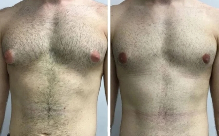 Diet and Lifestyle Tips After Gynecomastia Surgery in Dubai