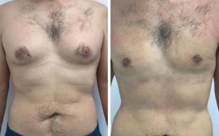 How to Maintain Results After Gynecomastia Surgery in Dubai