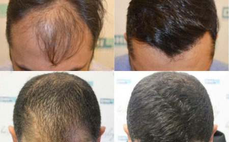 Regain Your Hair with Confidence: Hair Transplantation in Delhi