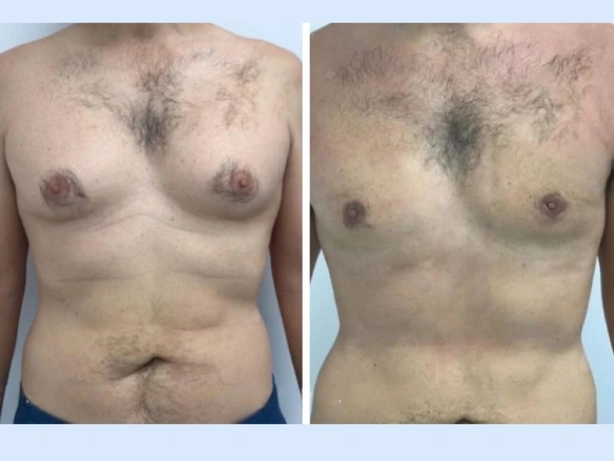How to Maintain Results After Gynecomastia Surgery in Dubai