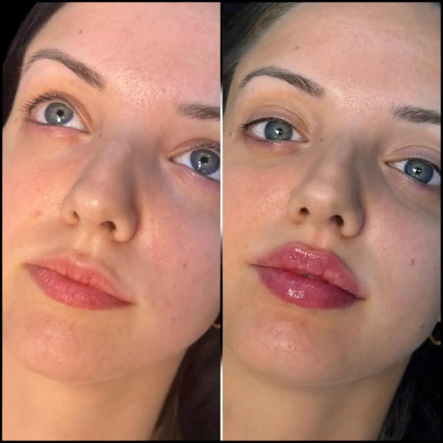 The Science Behind Fillers Treatment in Dubai for Facial Rejuvenation