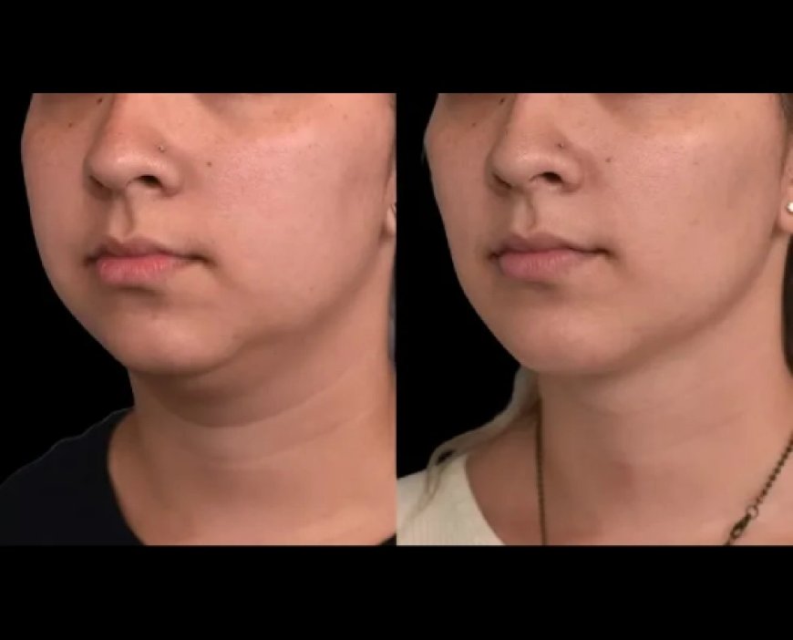Combining Double chin removal in Dubai with Other Facial Procedures