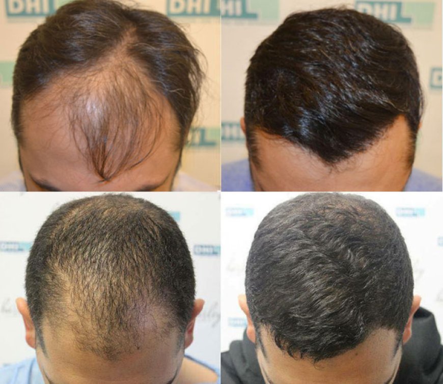 Regain Your Hair with Confidence: Hair Transplantation in Delhi