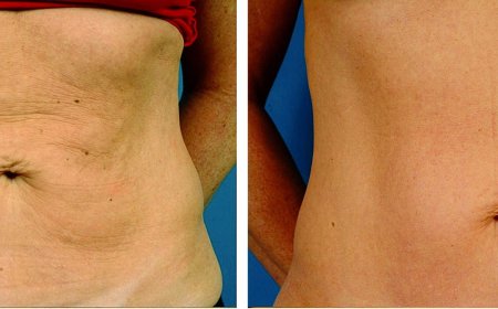 Viora Treatment – A Simple Guide for Everyone