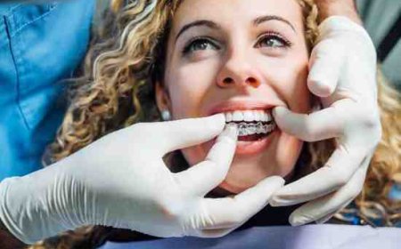Is Invisalign Right for You? Let’s Break It Down