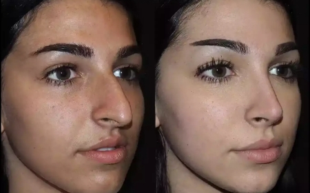 Advanced Techniques in Nose Surgery Now Available in Dubai