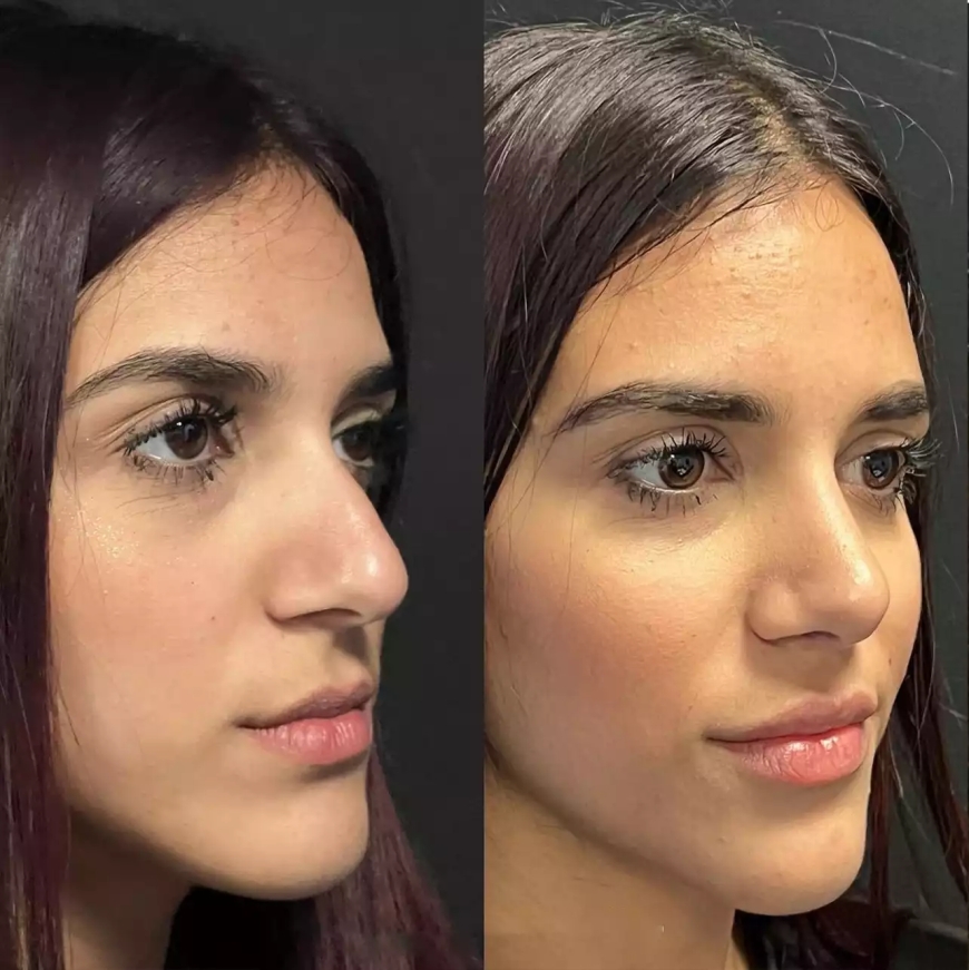 Septoplasty in Dubai vs. Rhinoplasty: What's the Difference?